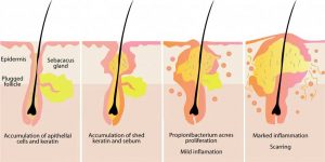 Chinh Phục Làn Da Dầu Mụn