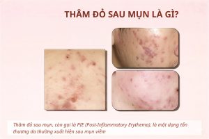 Bí Quyết Chọn Serum Trị Thâm Mụn