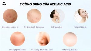 Top 7 Kem Trị Mụn Ẩn