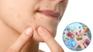 Chinh Phục Làn Da Dầu Mụn