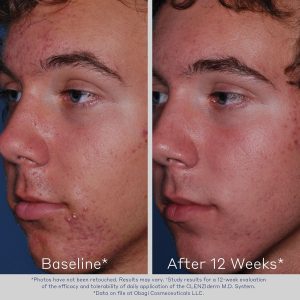 Top 7 Kem Trị Mụn Ẩn