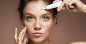 Top 7 Kem Trị Mụn Ẩn